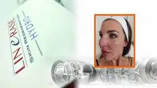 Mój zabieg - odc. 21 - Linerase Hydro (kwas hialuronowy+aminokwasy) prezentacja i omówienie zabiegu