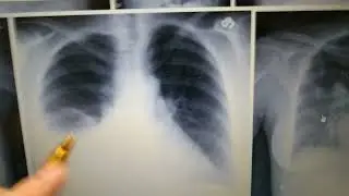 Pulmonology- Radiology- Pleural Effusion Chest X-ray- Loss Of Costophrenic Angle