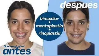 Cirugía bimaxilar Caso #183: Nora -Clase II, Sonrisa gingival