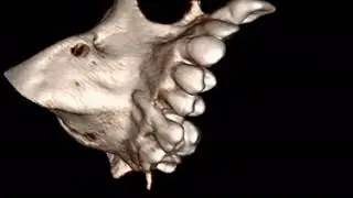 Vertical Incisor Root Fracture