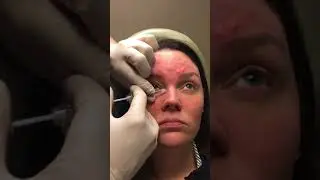 Botox For Bunny Lines | Kalos Facial Plastic Surgery LLC | Atlanta, Buckhead, GA