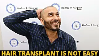 Finally Removed All my hair first day of hair transplant | Born Creator