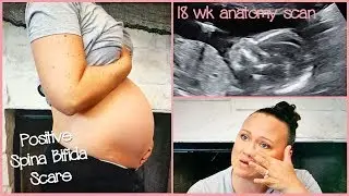 Scary Blood Screen Results! | Wks 16-20 | Anatomy Scan | Its Ashley Williams