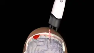 InfraScanner Handheld Brain Injury Diagnostics &ndash; Sports Medicine