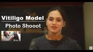 കേരളത്തിലെ രണ്ടാമത്തെ Vitiligo Model Photo&nbsp;Shoot | Benssy | Bose Media | Midhun Bose