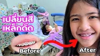 พาออมเล็ต ไปเปลี่ยนสียาง เหล็กจัดฟัน ตามนัด