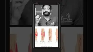 Limb Lengthening: Permanent or Temporary? are results of limb lengthening surgery permanent?