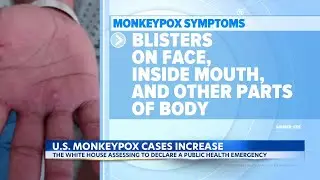 After WHO declares public health emergency, monkeypox vaccine available to exposed groups