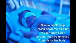 What is Phototherapy and why are eyes covered during Phototherapy.