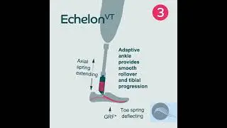 The Echelon VT has e-carbon foot spring technology #endolite #artificiallimb #endoliteindia #linx