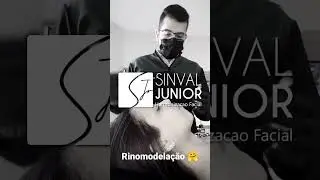 ✴️RINOMODELA&Ccedil;&Atilde;O✴️ mudan&ccedil;a no contorno do nariz com &aacute;cido hialur&ocirc;nico!! #preenchimento #rinomodela&ccedil;&atilde;o