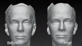 Radiesse® to Restore Volume in Those Neglected Temples