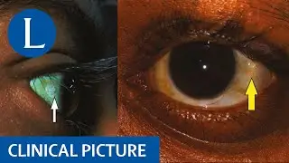 Bitot's spots, dry eyes, and night blindness indicate vitamin A deficiency