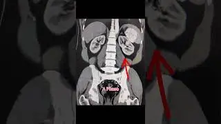 Splenic Hemangioma #ctscan #radiology #ctabdomen #radiologystudent