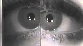 Horner's syndrome: Dilation Lag