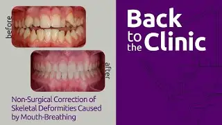 Non-Surgical Correction of Skeletal Deformities Caused by Mouth-Breathing - Back to the Clinic #006