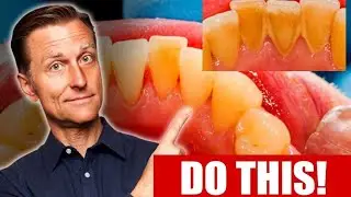 The Shocking Truth About Teeth Tartar&mdash;Dentists Warn You Must Know This! By Dr. Eric  Berg #trending