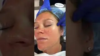 #BTS - VI Peel Precision Plus ￼