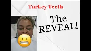 THE REVEAL | African American Woman Getting TURKEY TEETH