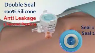 5 FEATURES TROCAR LAPAROSCOPIC YOU SHOUD KNOW