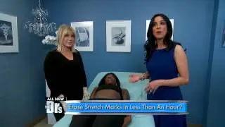Does This Stretch Mark Removal Procedure Work?