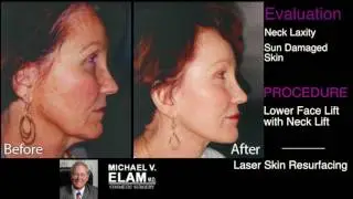 Rejuvenating One Woman's Face - Dr. Elam's Evaluation - #ElamFirstLook
