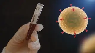 Post-COVID fibrosis a concern even for younger coronavirus patients