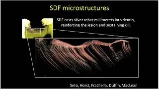 Silver Fluoride treatment for dental caries, 30min webinar