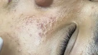 Deep Facial Cleansing ASMR | Acne Blackhead & Whitehead Removal#asmr 