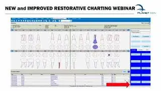 New and Improved Restorative Charting   Denticon Support Webinar