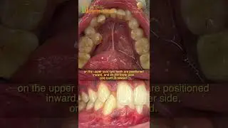 Natural Alignment: How Damon Braces Expanded an Arch and Avoided Extractions for a 23-Year-Old