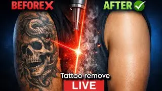 &ldquo;Permanent Tattoo Removal 😳 Before & After | सच में हट जाता है?&rdquo; || 😱 Real Laser Tattoo Removal😰