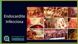Endocardite Infecciosa - Aula