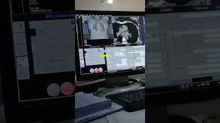 CT Cardiac Angiography | Siemens 384 Slice CT machine | Siemens Syngovia Workstation