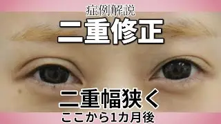二重修正の症例解説。幅狭くしてハム目をなくす、でも平行で二重幅ある程度欲しい手術後1か月／名古屋こいずみ形成クリニック