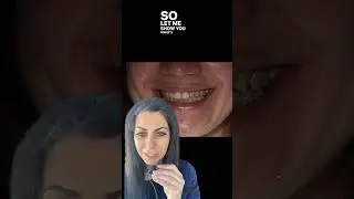 Natural porcelain crowns | smile makeover | Dr. Yazdan | how to make porcelain crowns look natural