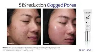 Retinol + Acne Complex