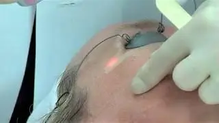 Micro Laser Peel laser skin resurfacing.wmv