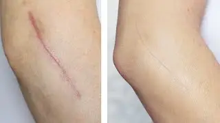 How To: Cover / Conceal A Scar