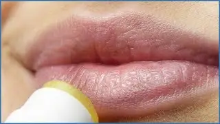 TREATMENTS FOR ANGULAR CHEILITIS