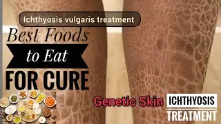 Top 10 Best Foods for Ichthyosis Vulgaris 🥗 | Natural Cure & Healthy Diet 🌿 | Dry Skin Healing Tips