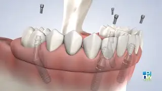 Full-Arch Replacement in King County WA | Pacific Northwest Oral & Maxillofacial Surgeons