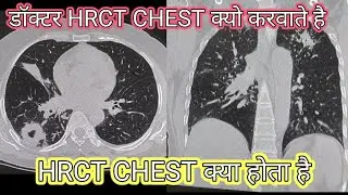 HRCT Chest kyo Doctor karate hai // CT chest symptoms # HRCT Chest# Ct chest kyo karana chahiye