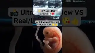 ✨ 8 Weeks Baby Growth 🍼❤️📸 Ultrasound View VS Real view #ultrasound #baby