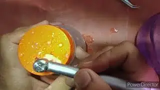 access opening in mandibular molar in natural tooth.