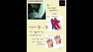 #Shorts | Clinical Correlation | NEET/NEXT PG/FMGE/MBBS | Holt Oram Syndrome | ASD | Down's Syndrome