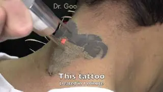 Tattoo removal back of neck M