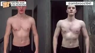 Watch @ambroos1641's Incredible Pectus Excavatum Gym Transformation in Just 150 Days