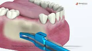 Cortical Bone Scraper