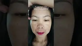 Acne & Melasma Journey✨ Thanks to Dermorepubliq my Holy Grail #shorts #dermorepubliqreview